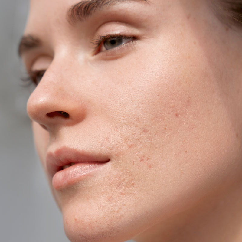 How to Choose the Best Toner for Acne-Prone Skin